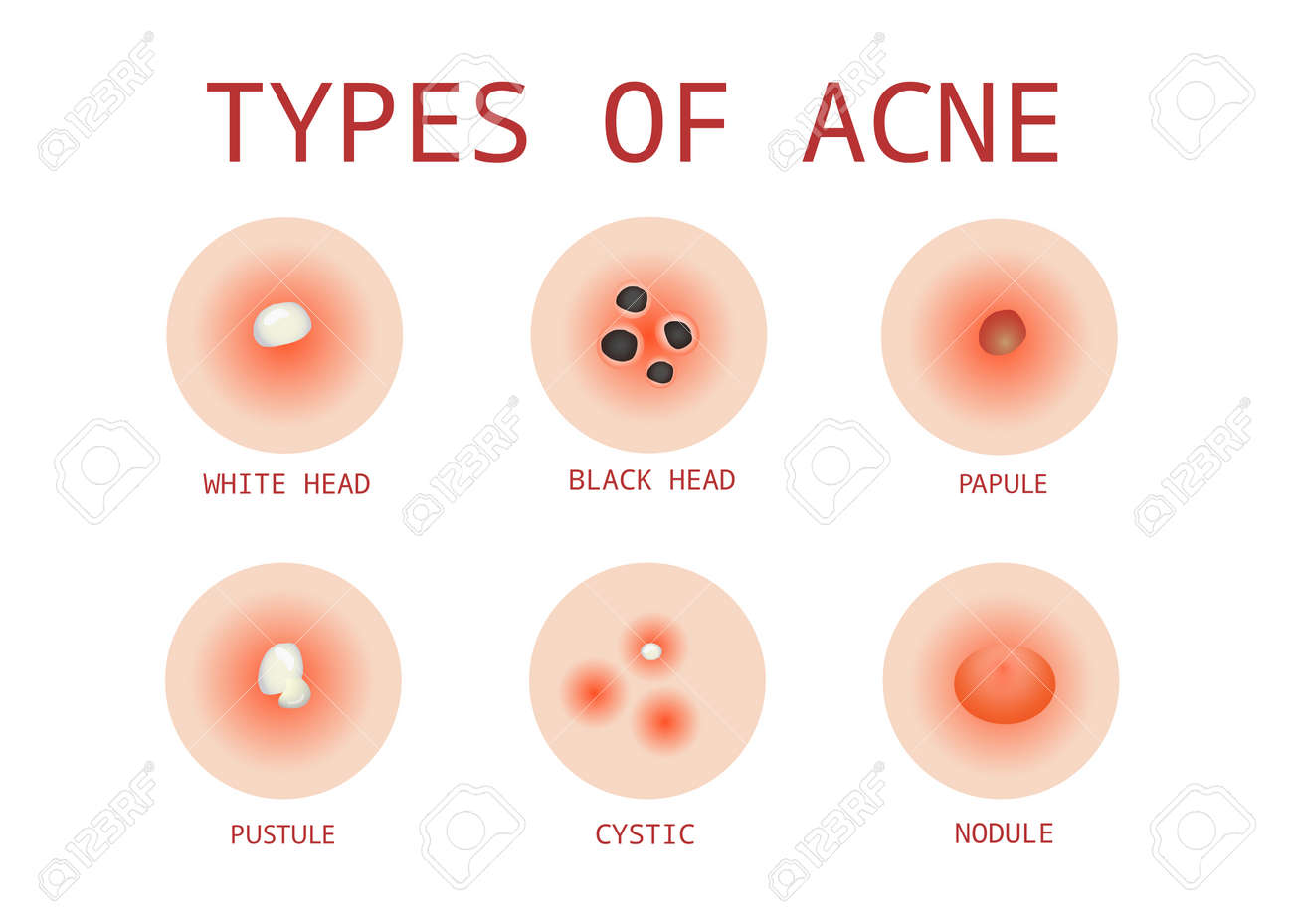 types-of-acne-vector